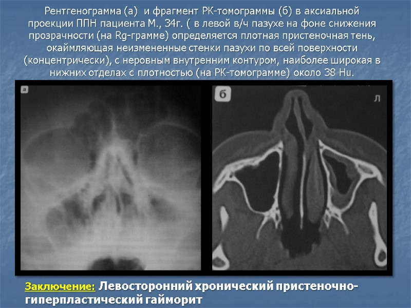 Рентгенограмма (а)  и фрагмент РК-томограммы (б) в аксиальной проекции ППН пациента М., 34г.